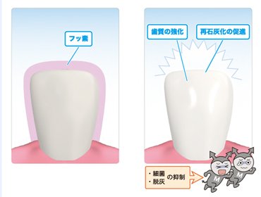 フッ素塗布