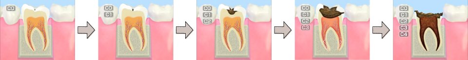 むし歯の発生要因及び進行度