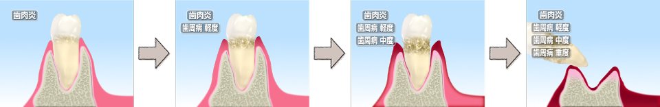 歯周病の発生要因及び進行度