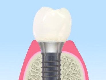 インプラント