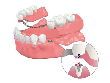磁性アタッチメント義歯