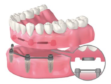 バーアタッチメント義歯