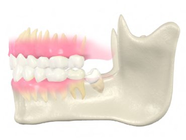親知らずの抜歯